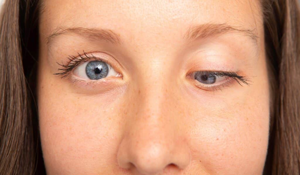 Crossed Eye Surgery - Strabismus Squint - Akıllı Lazer Göz Merkezi