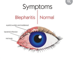 Blepharitis Treatment - Akıllı Lazer Göz Merkezi