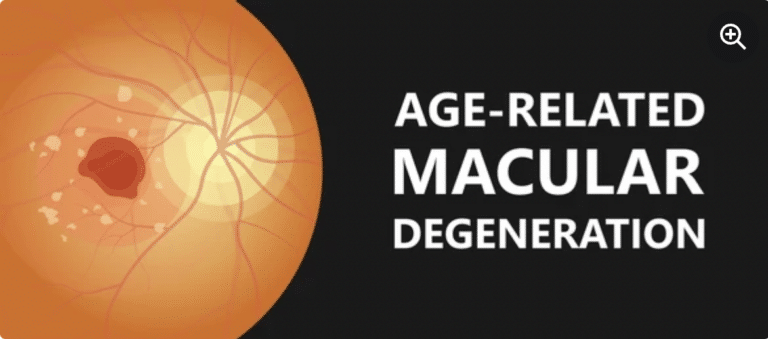 Macular Degeneration Treatment - Akıllı Lazer Göz Merkezi